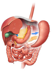Cirurgia Sleeve